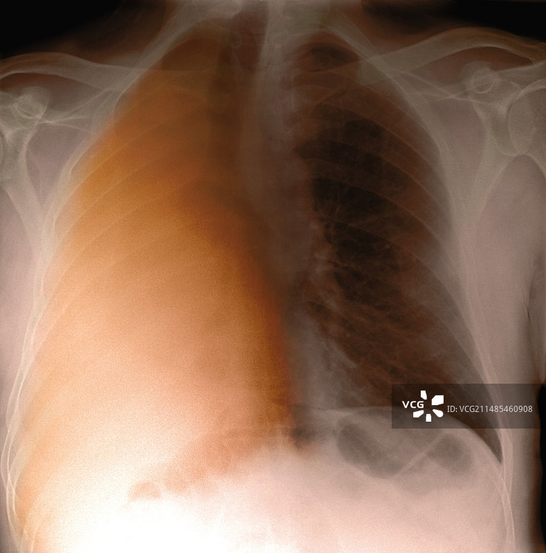 肺癌X光片图片素材