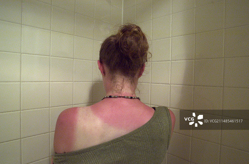 晒伤的背部图片素材