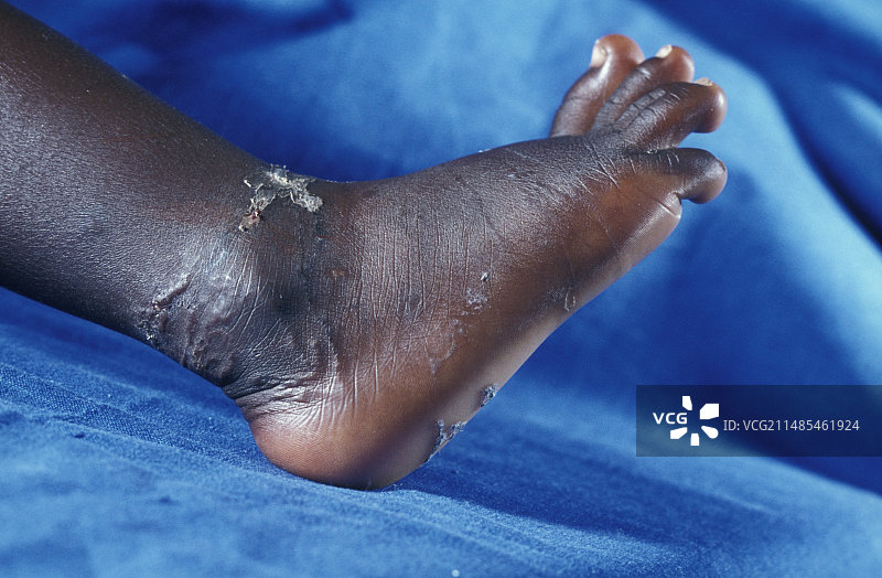 钩虫感染图片素材