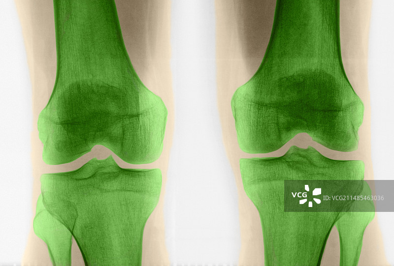 膝盖X光片图片素材