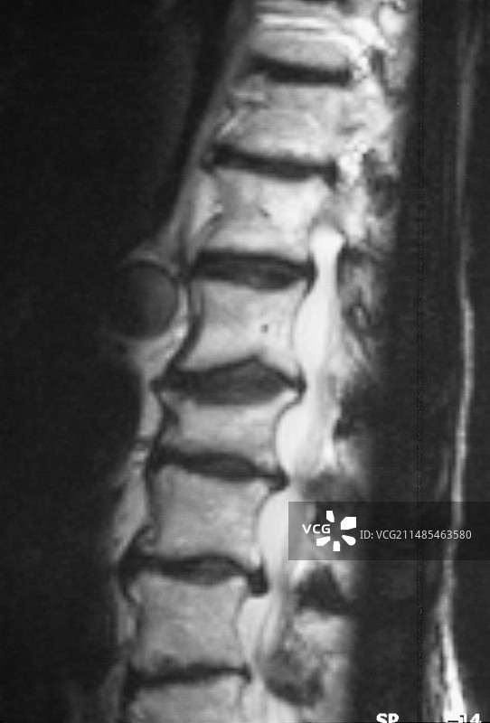 脊柱骨关节炎的核磁共振成像图片素材