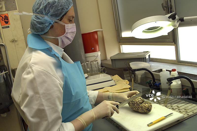 多发性硬化症脑部解剖图片素材