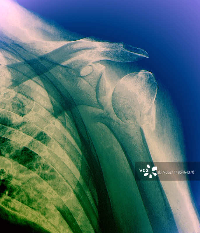 肱骨骨折X光片图片素材