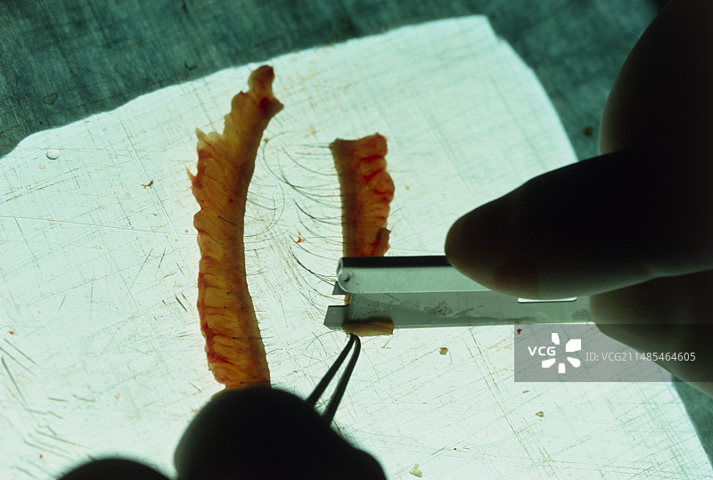 头发移植手术图片素材