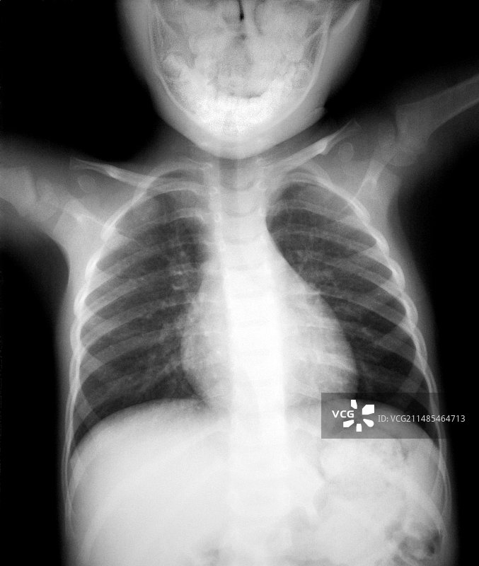 儿童正常的心脏和肺部X光片图片素材