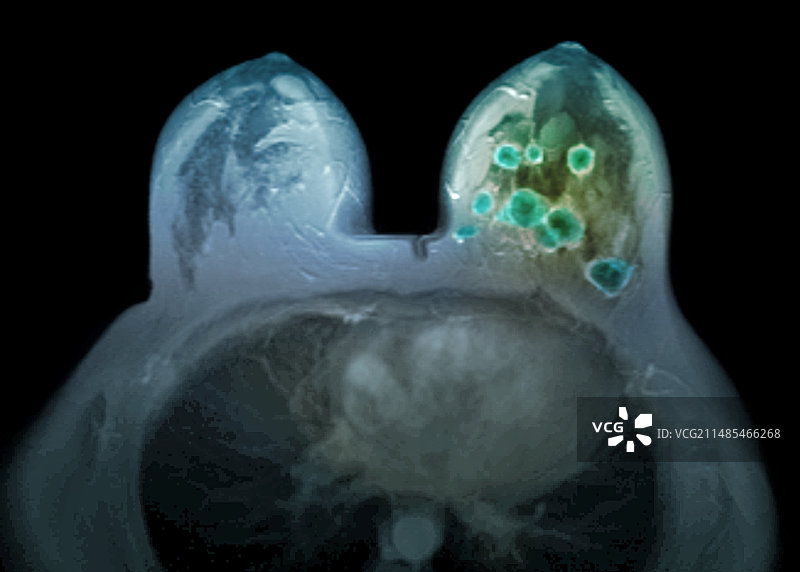 乳腺癌核磁共振扫描图片素材