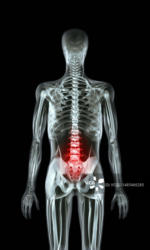 背痛X光图片素材