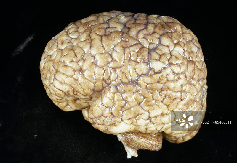 小脑回畸形脑部疾病图片素材