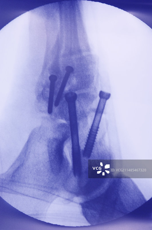 踝关节固定X光片图片素材