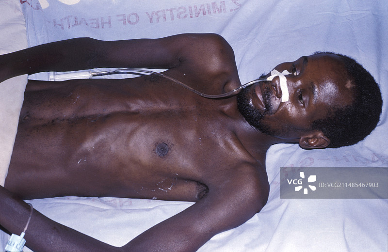 破伤风感染图片素材