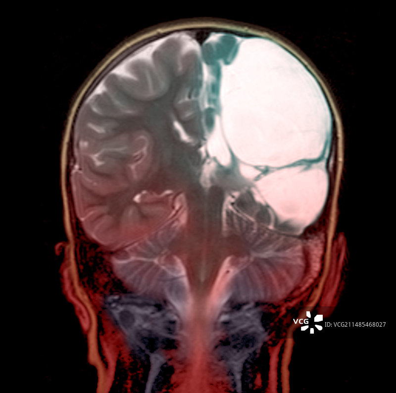 脑瘫，核磁共振扫描图片素材