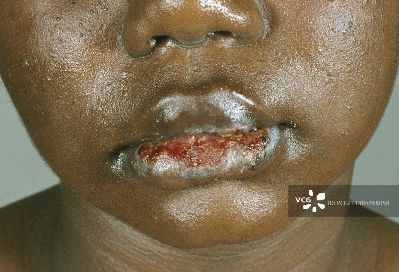 对药物过敏的艾滋病患者图片素材