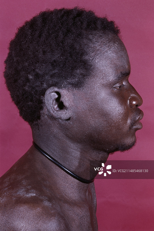 银屑病治疗后的艾滋病患者图片素材