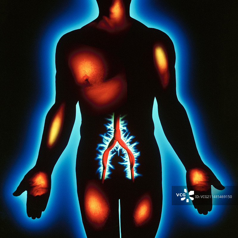 主动脉移植图片素材