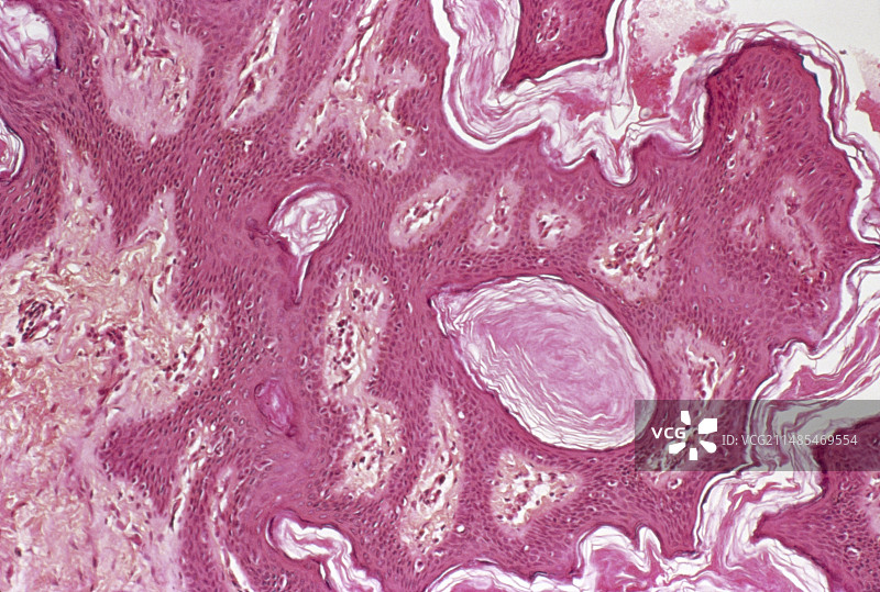 疣状皮肤痣显微照片图片素材