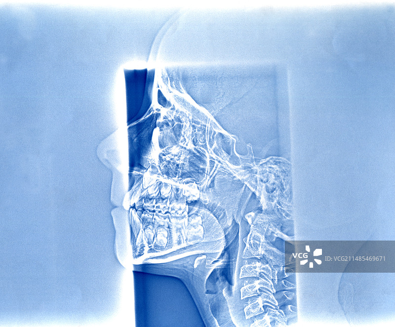 人类头骨X光片图片素材