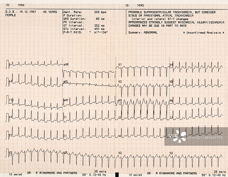 心脏疾病心电图图片素材
