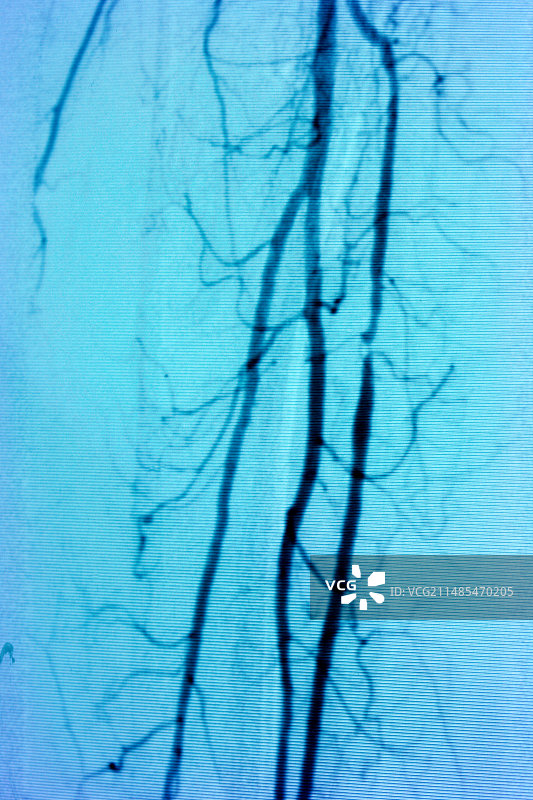 腿部血管狭窄血管造影图片素材