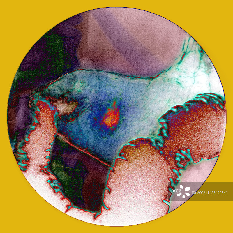 胃溃疡X光片图片素材