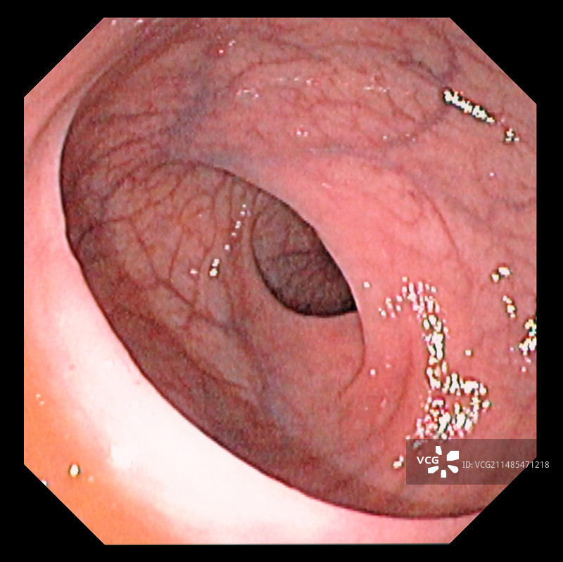 直肠瓣图片素材