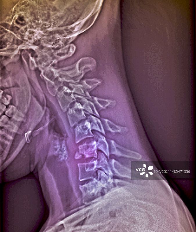 颈部骨折X光片图片素材