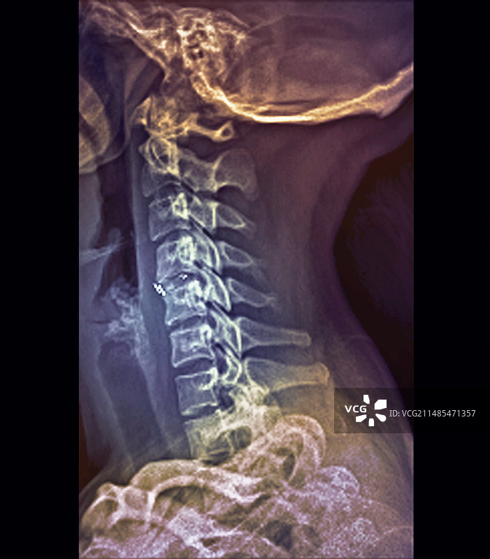 椎间骨移植X光片图片素材