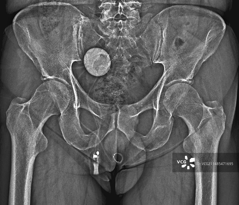 人工尿道括约肌X光片图片素材