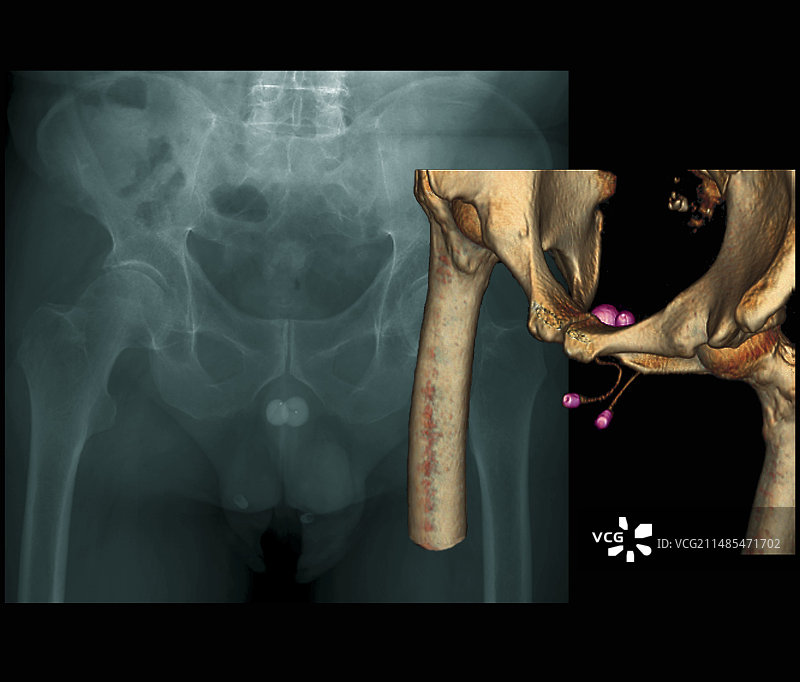 人工尿道括约肌图片素材