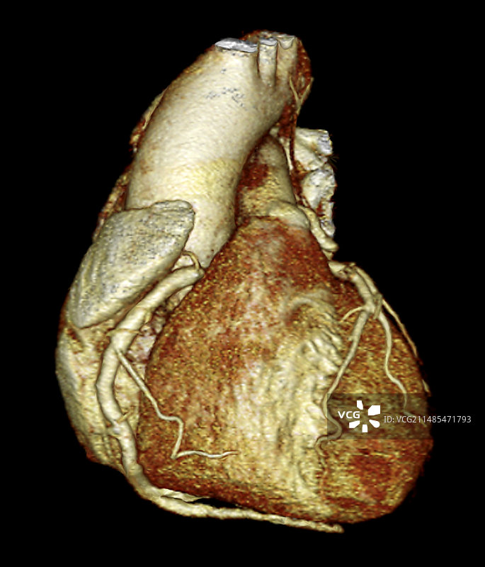 主动脉瘤3D CT扫描图片素材