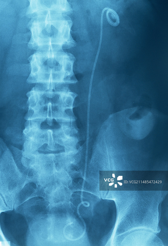 泌尿系统支架X光片图片素材