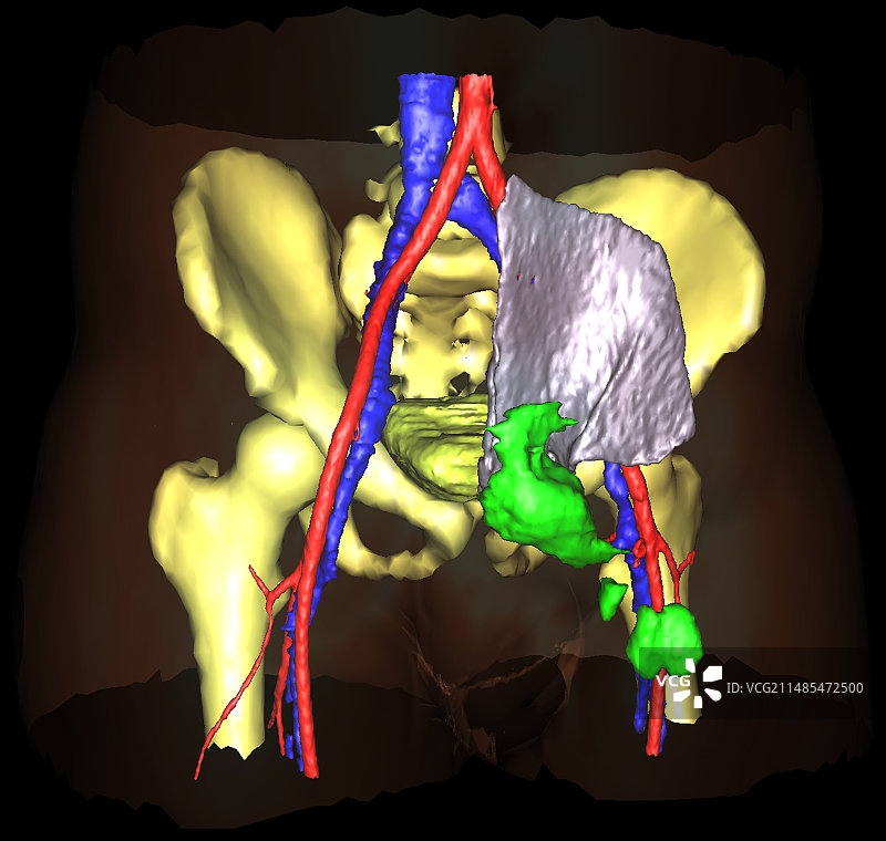 腿部继发性癌症的3D核磁共振扫描图片素材