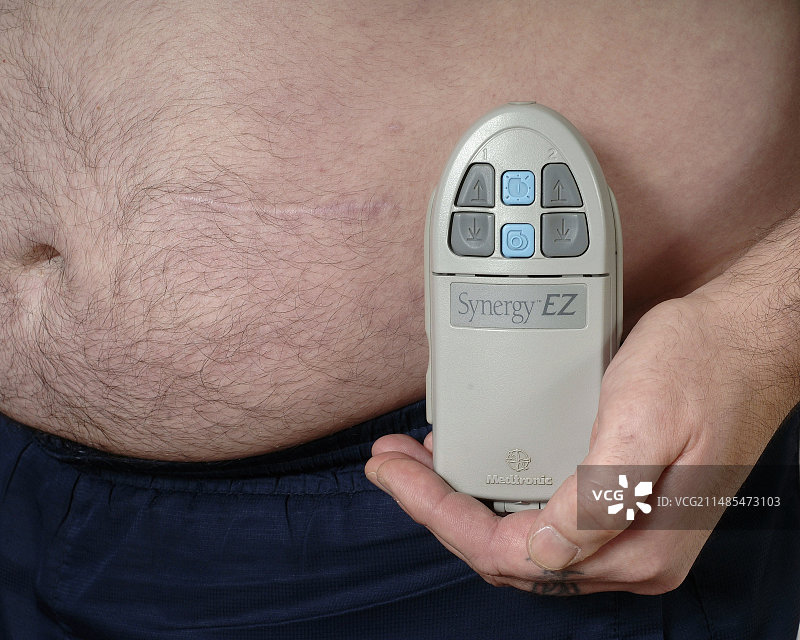 止痛植入物图片素材