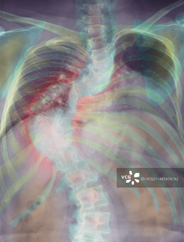 脊柱侧弯的脊柱X光片图片素材
