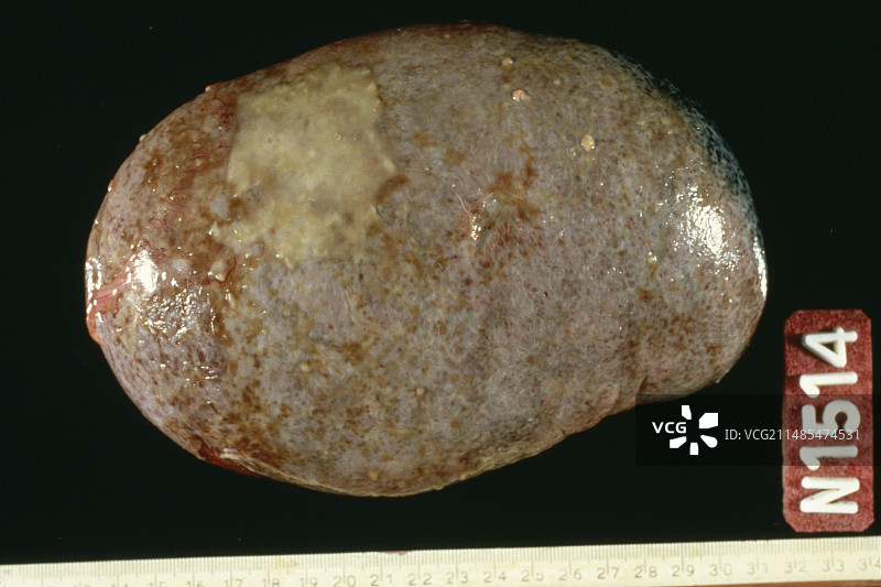 瓦尔登斯特伦病脾脏图片素材