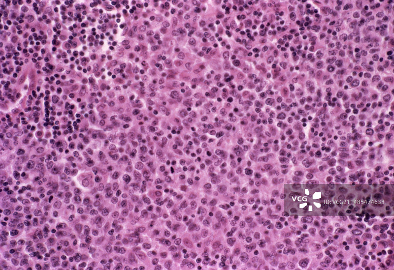 霍奇金病，光学显微照片图片素材