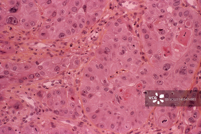 食道癌光学显微照片图片素材
