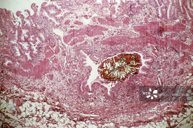 胆结石，光学显微照片图片素材