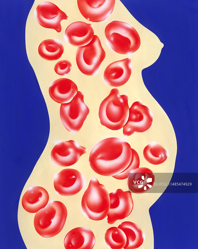 妊娠期贫血，艺术作品图片素材