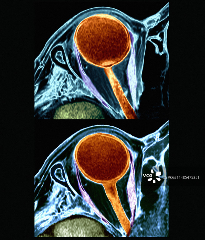 眼癌，核磁共振扫描图片素材