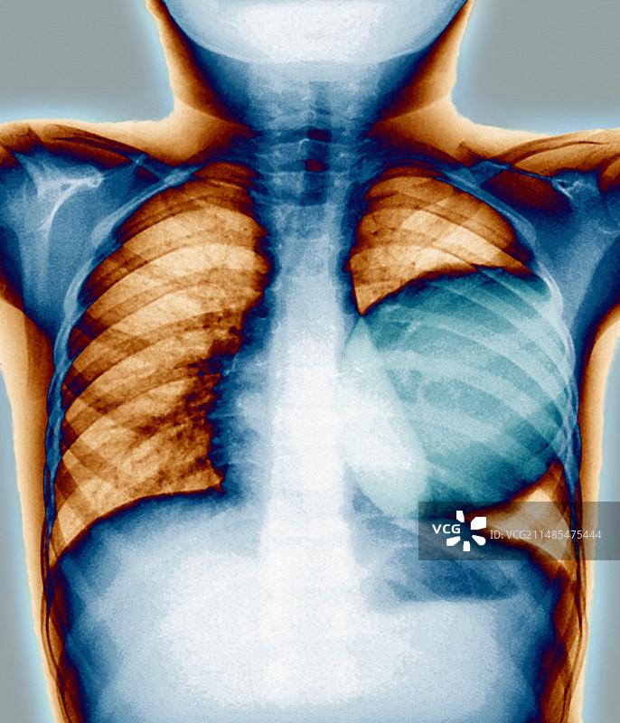 肺部囊肿，胸部X光片图片素材