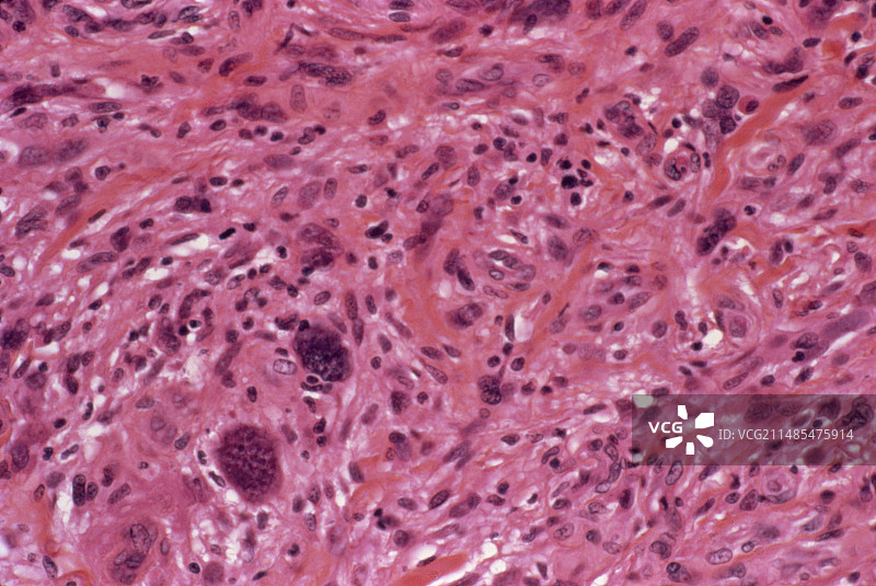 组织细胞瘤癌细胞图片素材
