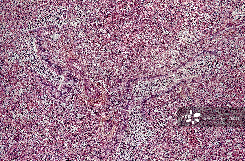 支气管肺炎图片素材