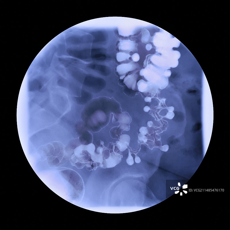 肠憩室病X光片图片素材