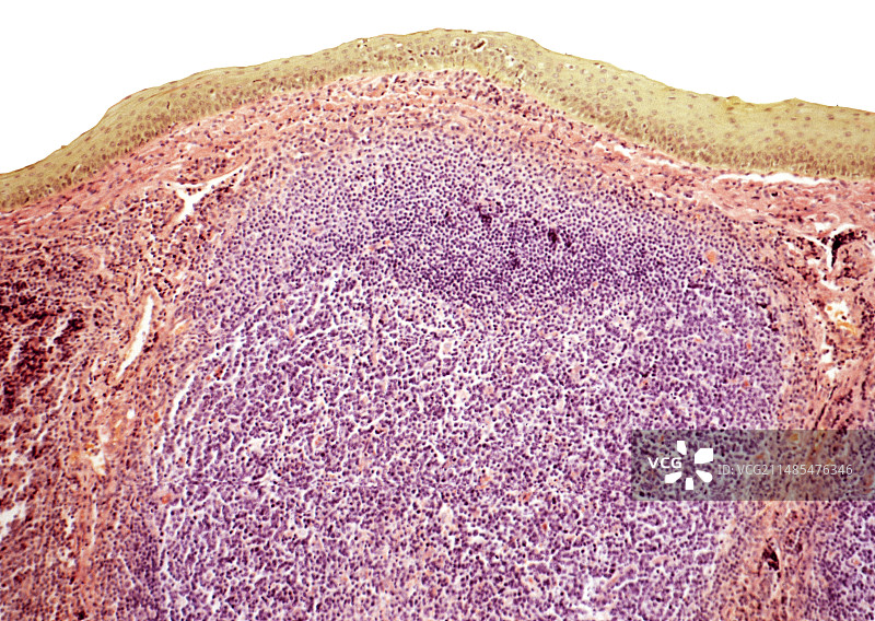 扁桃体，光学显微照片图片素材