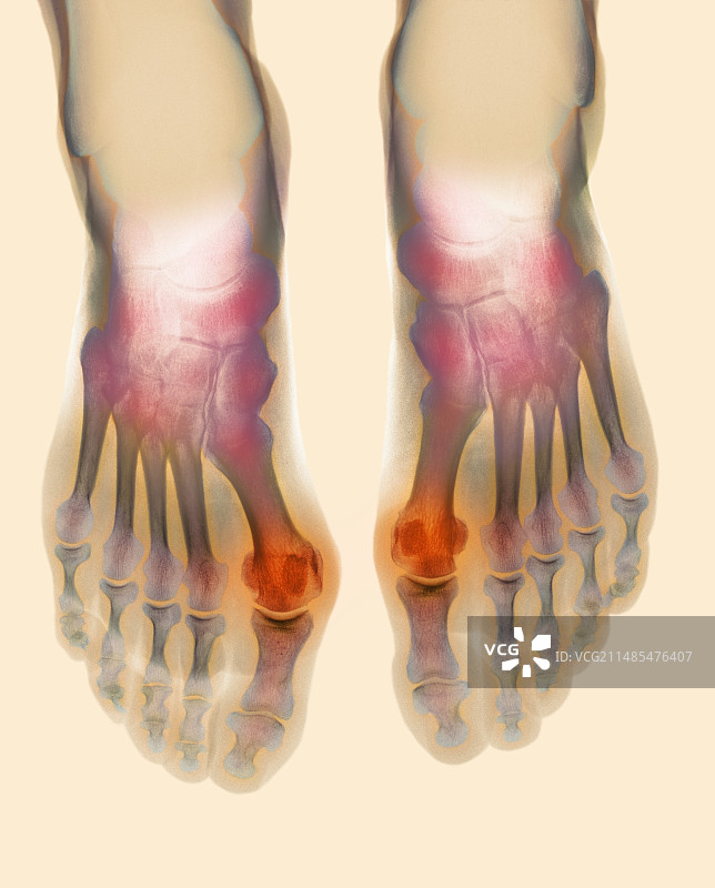 拇囊炎X光片图片素材