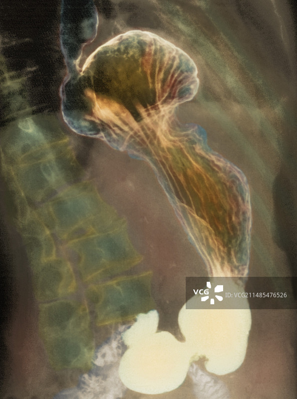 食管裂孔疝X光片图片素材