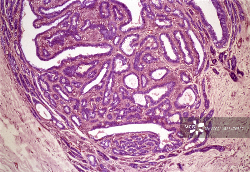 乳腺纤维腺瘤显微照片图片素材