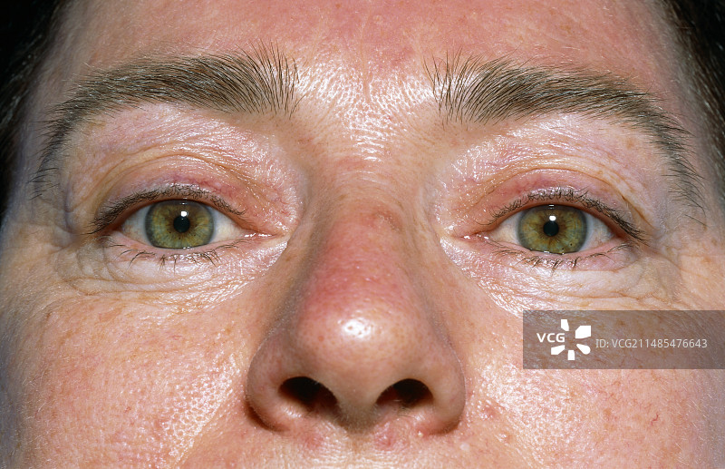 眼睑整形手术患者图片素材