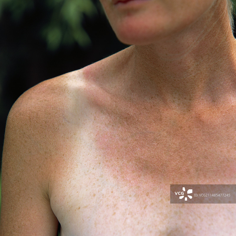 晒伤的皮肤图片素材