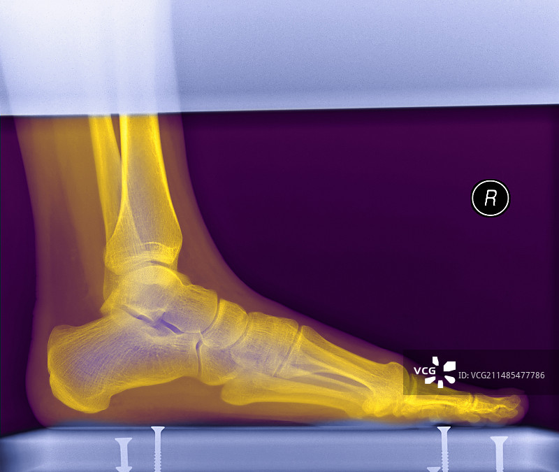 足部X光片图片素材